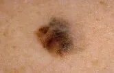 melanoma.jpg